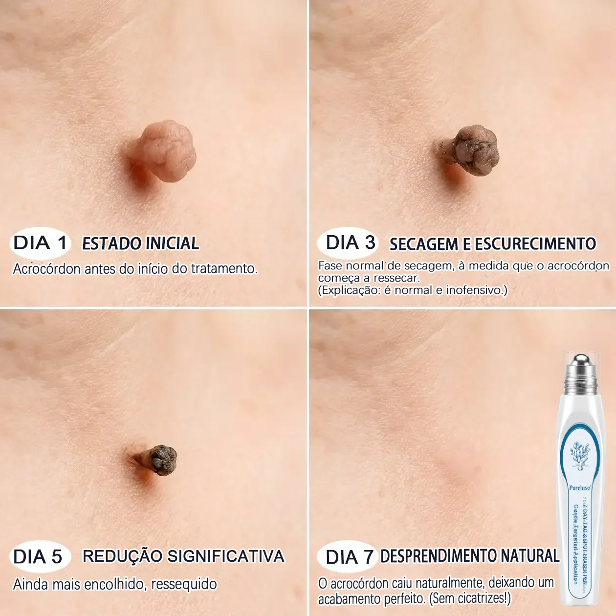 Loja Oficial 𝑷𝒖𝒓𝒆𝒍𝒖𝒙𝒐® 🌿 Tratamento de 7 Dias para Sinais e Imperfeições da Pele | Roll-on de Precisão, Sem Dor