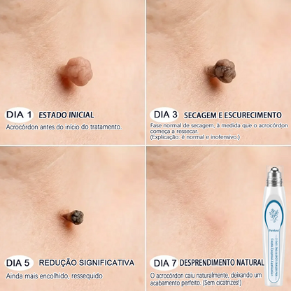 Loja Oficial 𝑷𝒖𝒓𝒆𝒍𝒖𝒙𝒐® 🌿 Tratamento de 7 Dias para Sinais e Imperfeições da Pele | Roll-on de Precisão, Sem Dor